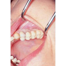 DirectCrown®, Posterior Bridge Kit