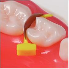 FenderPrime® Wedge, 18/Pkg