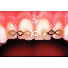 TTS Titanium Trauma Splints