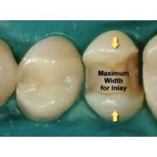 Dr. Christensen's Esthetic Alternatives For Crowns DVD