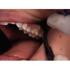 Dr. Christensen's Easy Third Molar Extraction DVD