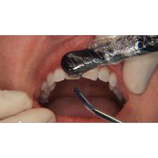 Dr. Christensen's Direct Resin Veneers DVD
