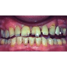 Dr. Christensen's Bruxism – Prevention and Treatment DVD