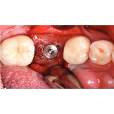 Dr. Christensen's Simplified Implant Surgery DVD