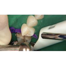 Dr. Christensen's Class II Composite Resins Can Be Predictable, Non-Sensative and Profitable DVD