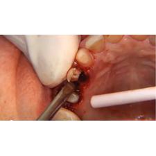 Dr. Christensen's Socket Preservation and Bone Grafting DVD