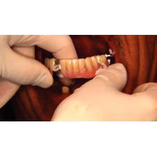 Dr. Christensen's Predictable Removable Partial Dentures DVD