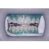 Venus White® Max Light Cure Gingival Barrier – 1.2 ml Syringes, 4/Pkg