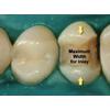 Dr. Christensen's Esthetic Alternatives For Crowns DVD
