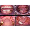 Dr. Christensen's Restoring Mini Implants DVD