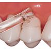 Matrices cervicales transparentes Cure-Thru®, emballage assorti