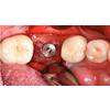 Dr. Christensen's Simplified Implant Surgery DVD
