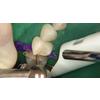 Dr. Christensen's Class II Composite Resins Can Be Predictable, Non-Sensative and Profitable DVD