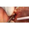 Dr. Christensen's Socket Preservation and Bone Grafting DVD
