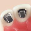 Patterson® Orthodontic Bite Blocks – Anterior, 10/Pkg